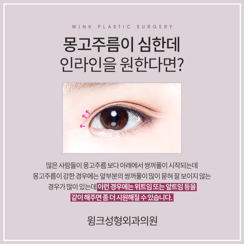 A Natural Line That Looks Just Like Your Original Eyes: In-line Double Eyelids image 5