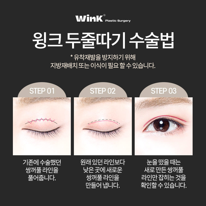 신사역쌍꺼풀재수술 알아본다면? 윙크성형외과 두줄따기눈재수술 관련 이미지 7