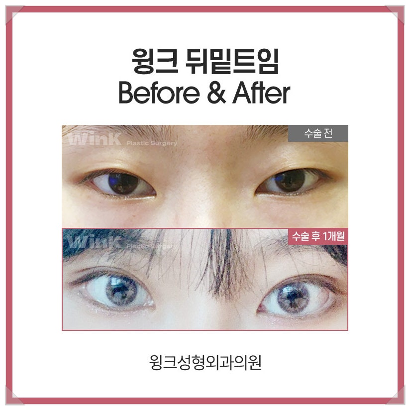 If You’re Looking Into Reviews of Dual Canthoplasty That Softens a Fierce Look image 4