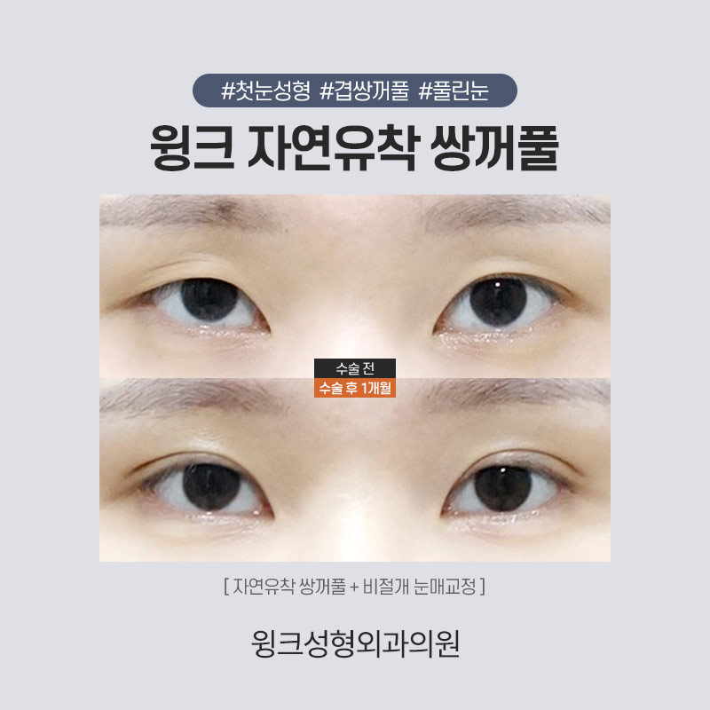 자연유착 쌍꺼풀수술로 겹주름을 해결하려면? 관련 이미지 4