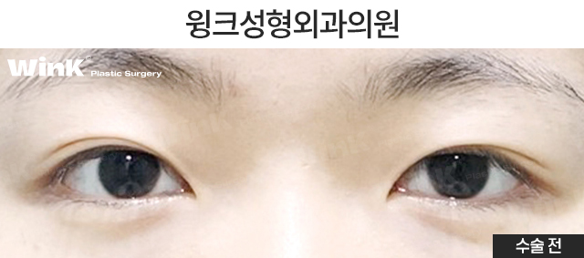 Should We Leave Eyelid Tape and Eyelid Glue Behind with Natural Adhesion Double Eyelid Surgery? image 5