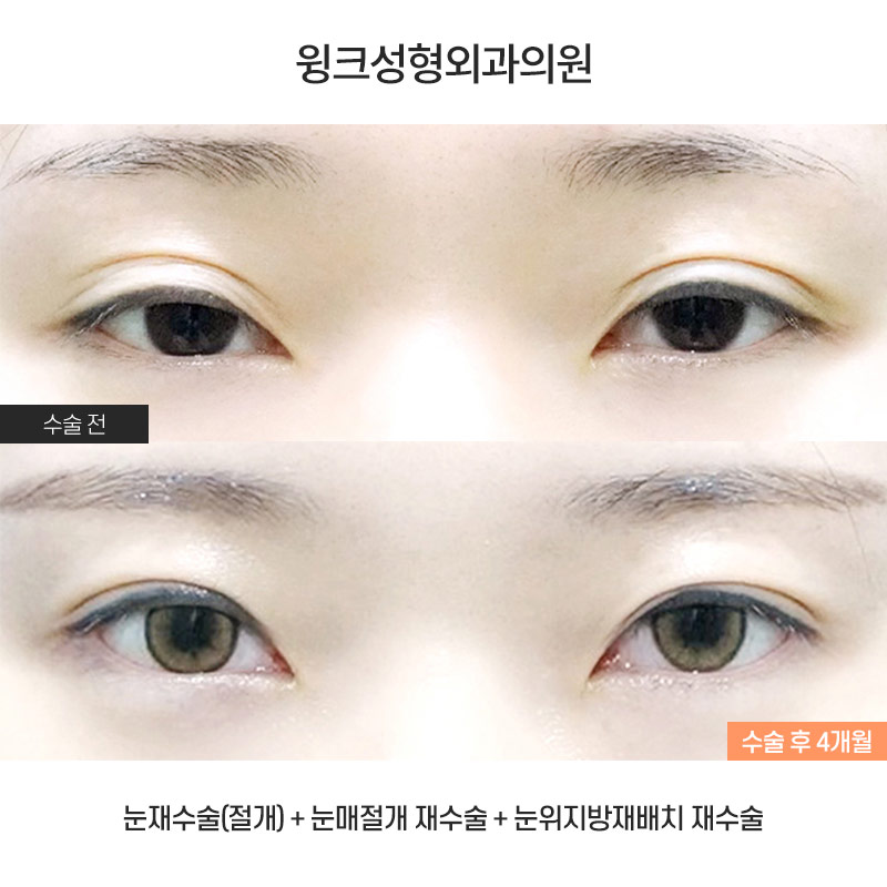 Case Examples of Correcting Uneven Eyes Through Ptosis Correction image 1