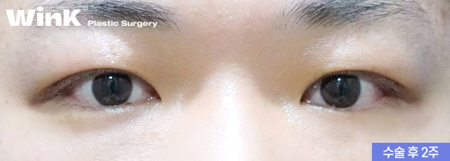 Monolid, inner double eyelid, or outer double eyelid? Choose the line that suits you! Men’s eye surgery at Wink Plastic Surgery image 3
