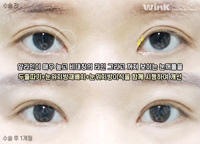 Lowering the Double Eyelid Line: Making Thick Double Eyelids (Sausage Eyes) Look Natural with a Two-Line Revision Surgery! image 8