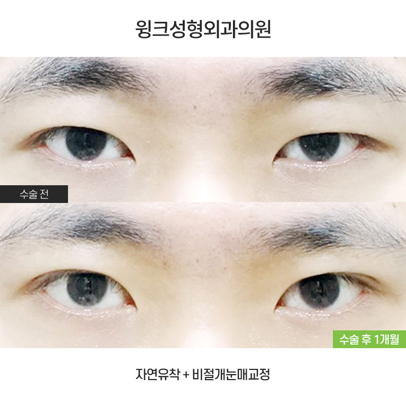 남자 속쌍꺼풀 눈매교정에 대해 알아볼까요? 관련 이미지 1