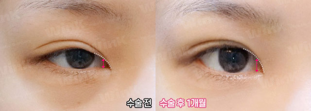 Wink Canthoplasty That Gently Lifts for a More Defined, Clear Eye Shape! image 6