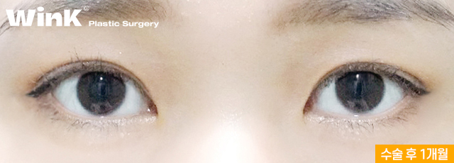 Wink Plastic Surgery’s Non-Incisional Ptosis Correction for Clearer Eyes Without an Incision! image 9