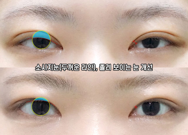 두줄따기 쌍꺼풀 라인낮추기로 부담스러운 눈매는 그만! 관련 이미지 11