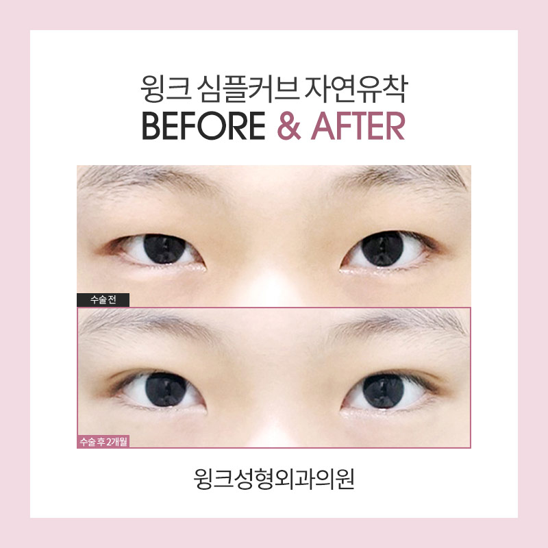 자연유착 쌍꺼풀 수술에 대해 알아보겠습니다. 관련 이미지 7