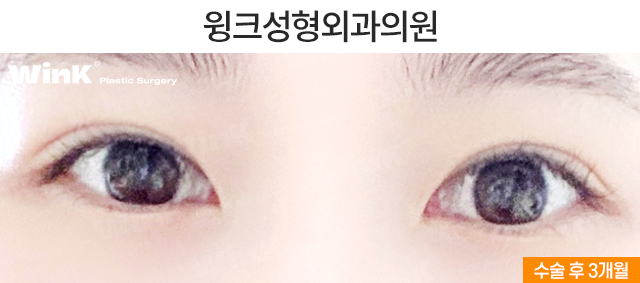 꼬막눈 쌍수도 시원하게! 눈성형 중점 진료 윙크성형외과 관련 이미지 6