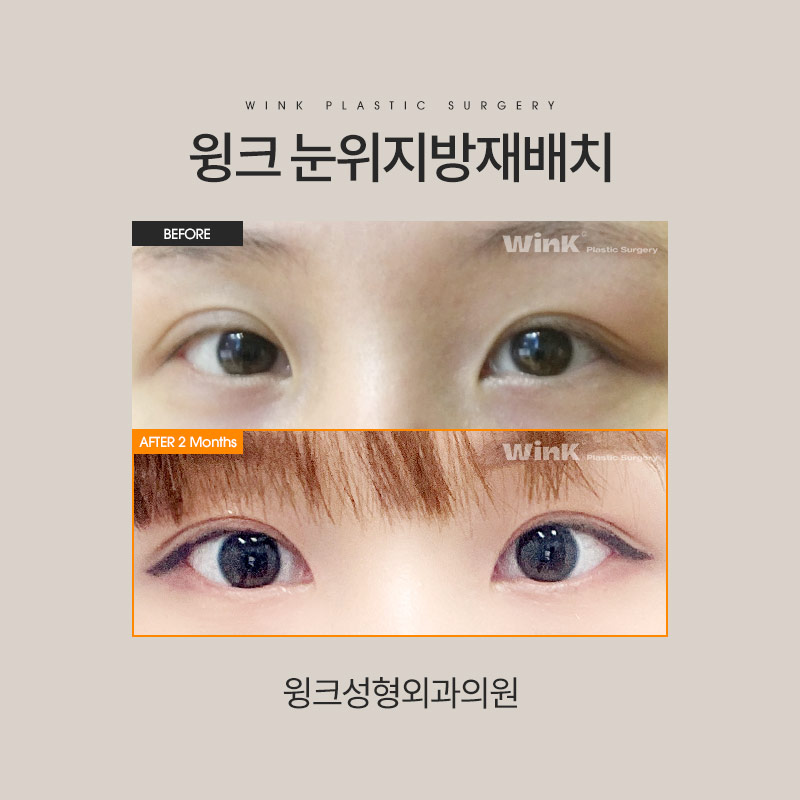 눈위지방재배치 눈지방재배치 꺼진 눈꺼풀을 생기 가득하게! 관련 이미지 6