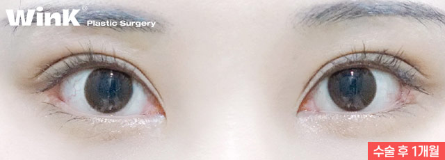 Wink Plastic Surgery Double Eyelid Revision Surgery, Pursuing Natural Results by Identifying the Exact Cause of Failure image 10