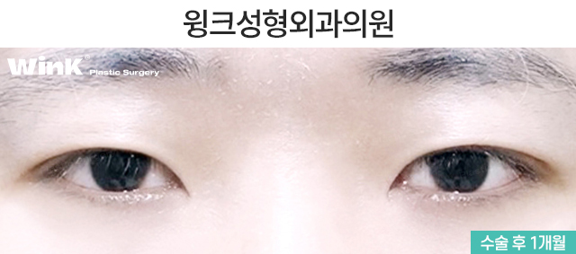 남자 자연유착 쌍꺼풀에 관해 알아볼까요? 관련 이미지 6