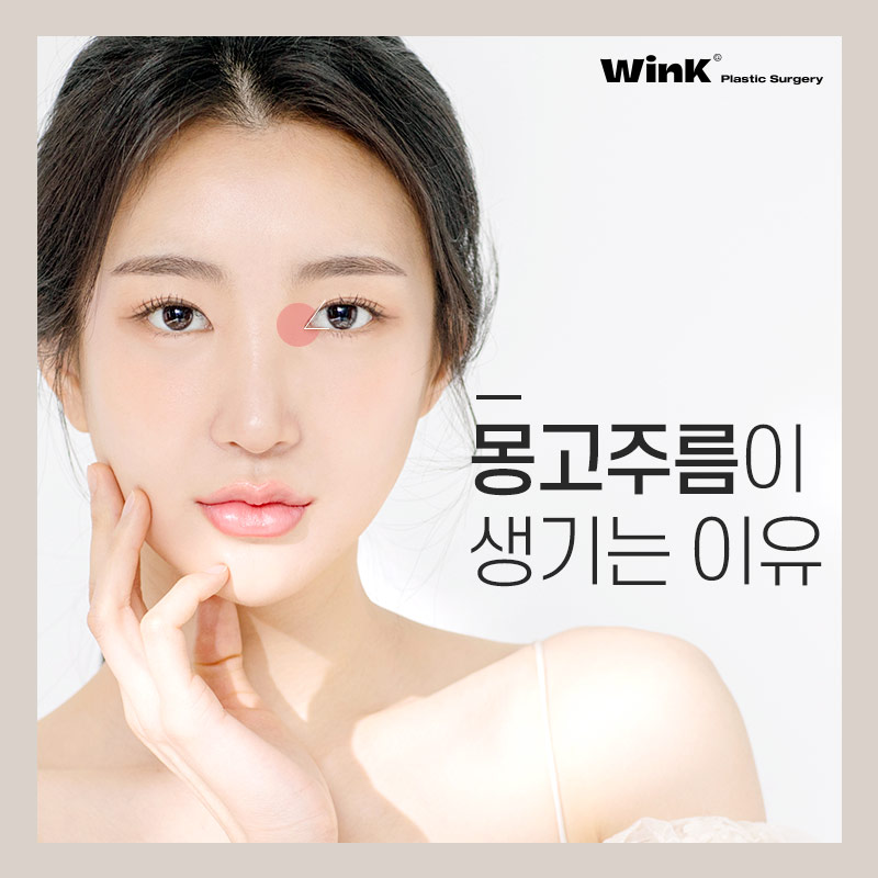 몽고주름이 쌍꺼풀 수술에 미치는 영향! 윙크성형외과에서 알려드려요 관련 이미지 1