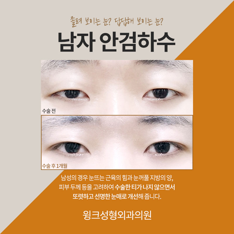 남자 안검하수 교정에 관해 알아보겠습니다. 관련 이미지 2