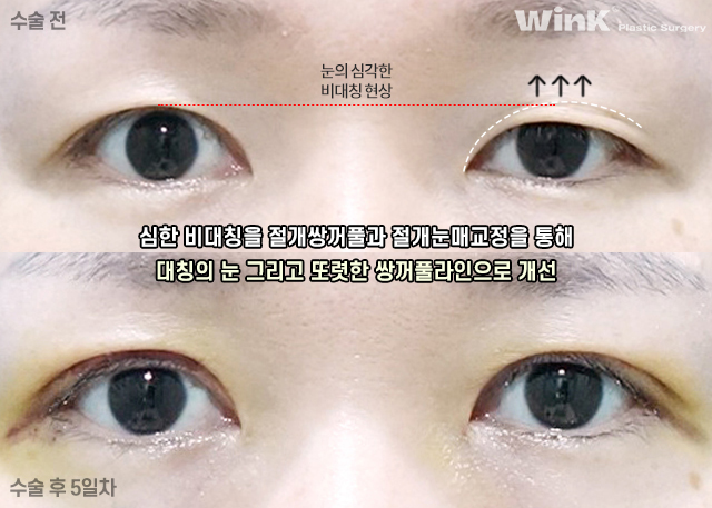 비대칭 안검하수 눈매교정은 어떻게 하는 것일까? 관련 이미지 4