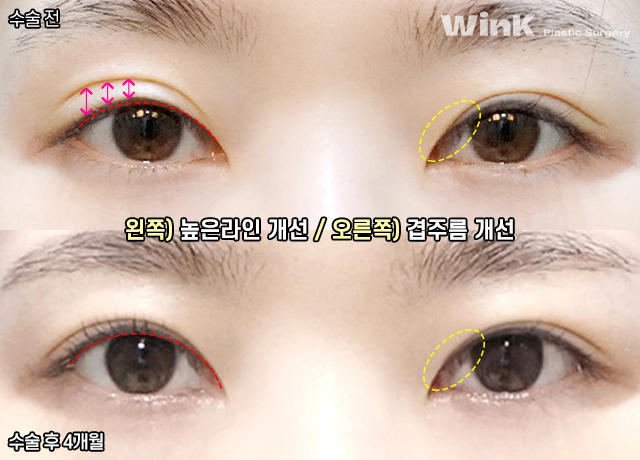높은 쌍꺼풀 라인, 겹쌍꺼풀과 같은 유형의 눈재수술 방법은? 관련 이미지 6