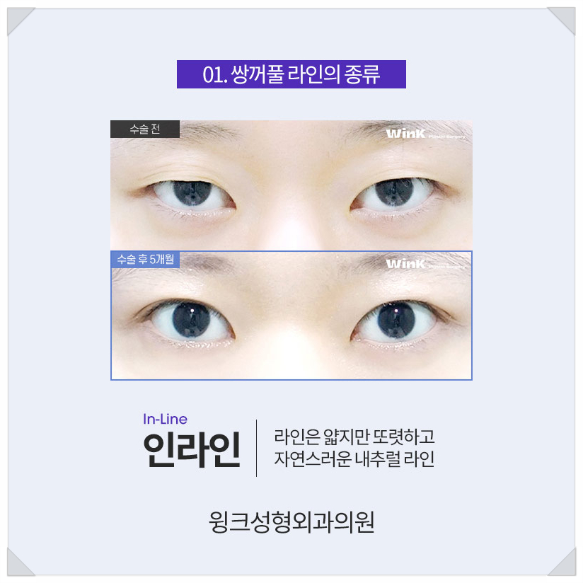 아이린눈 인아웃연예인?  윙크성형외과와 알아보는 쌍꺼풀라인종류! 관련 이미지 4
