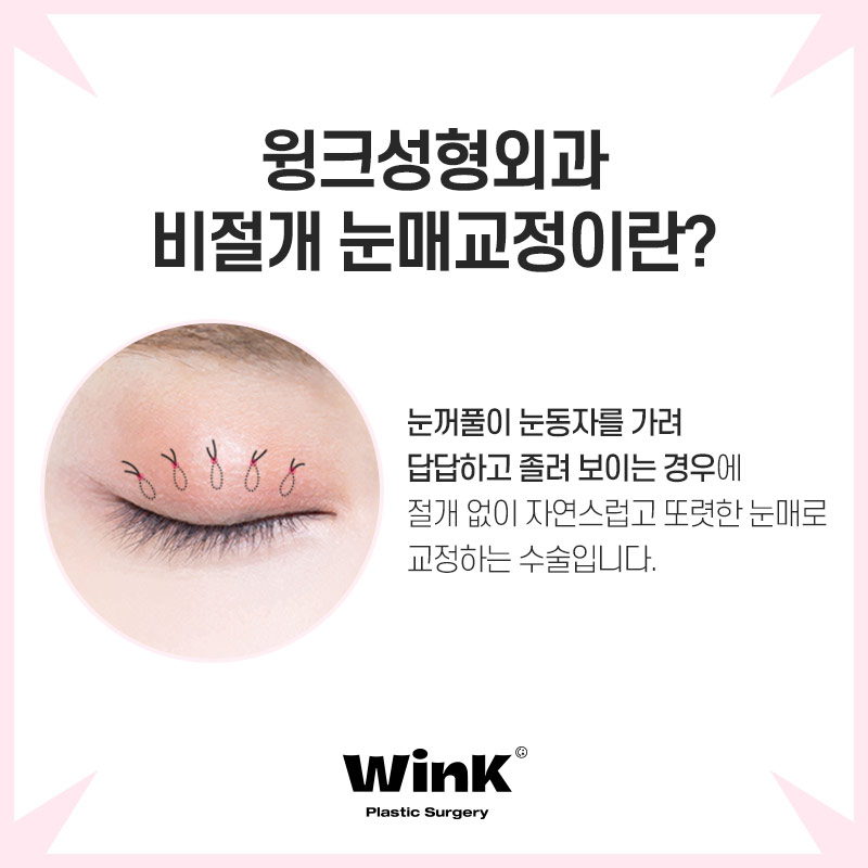 Wink Plastic Surgery Eye Correction for a Natural Look That Doesn't Stand Out image 4