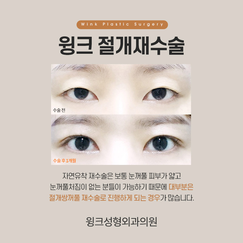 절개쌍꺼풀 절개재수술 흉터도 자연스럽고 깨끗하게! 관련 이미지 2