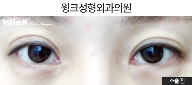 Let’s Learn About Double-Eyelid Revision Surgery with an Incision for a Thick Front Line image 2