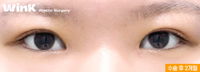 Is Fast Recovery Only Possible with Non-Incisional Surgery? At Wink Plastic Surgery, Incisional Double Eyelid Surgery Can Also Return You to Daily Life Quickly! image 3