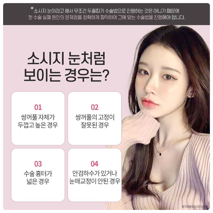 Revision Surgery for Sausage-Like Double Eyelids: Lowering the Double-Eyelid Line, Wink Plastic Surgery Sausage-Eye Revision Review image 3