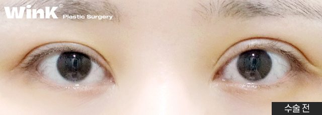Thick Double Eyelids, “Sausage Eyes.” Let’s Improve Them Naturally with Wink’s Double-Incision Double Eyelid Revision Surgery! image 3