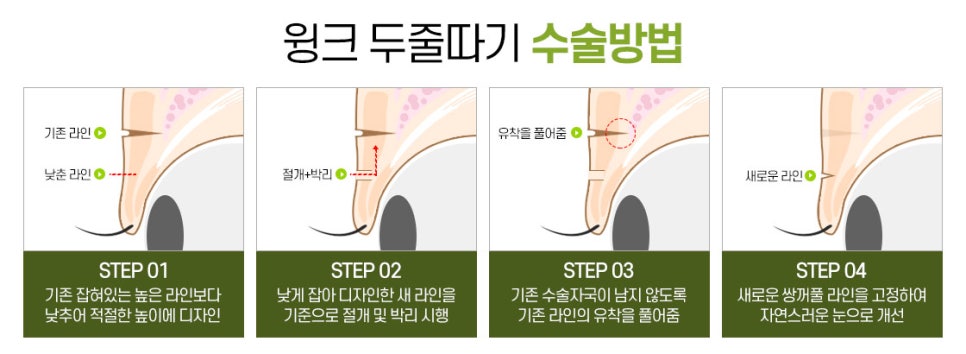 Thick Double Eyelids, “Sausage Eyes.” Let’s Improve Them Naturally with Wink’s Double-Incision Double Eyelid Revision Surgery! image 5