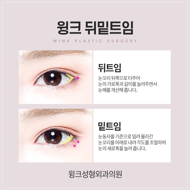 Shall We Learn About Canthoplasty and Dual Canthoplasty? image 3