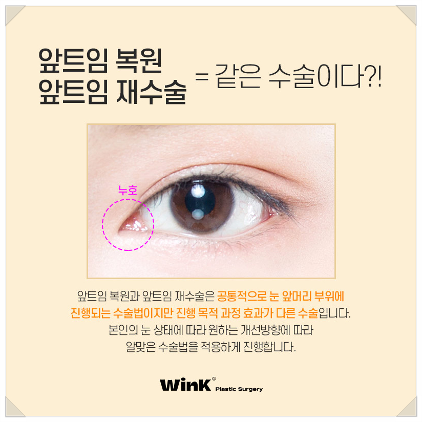 앞트임복원회복기간 앞트임복원후기 윙크성형외과 신사앞트임복원후기 앞트임부작용 관련 이미지 3