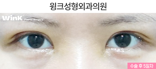 비대칭 안검하수 눈매교정은 어떻게 하는 것일까? 관련 이미지 6