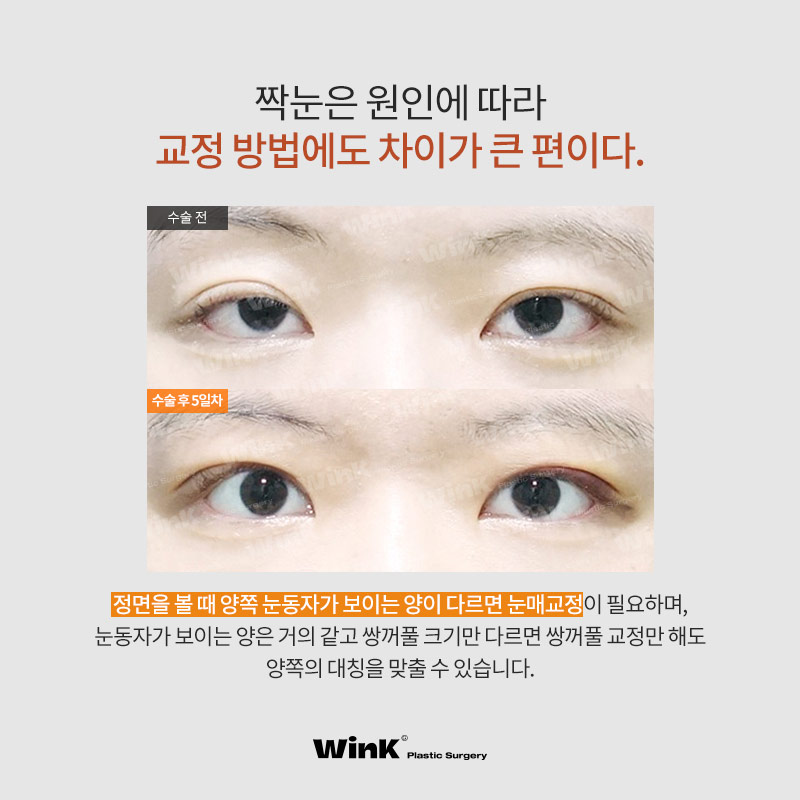 짝눈, 눈매교정으로 개선할 수 있을까? 윙크성형외과 눈매교정으로 가능해! 관련 이미지 5