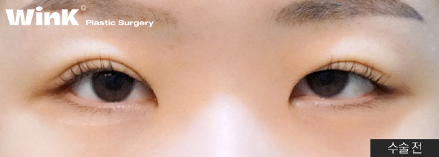 눈재수술 이런분들께 추천드립니다! 관련 이미지 4