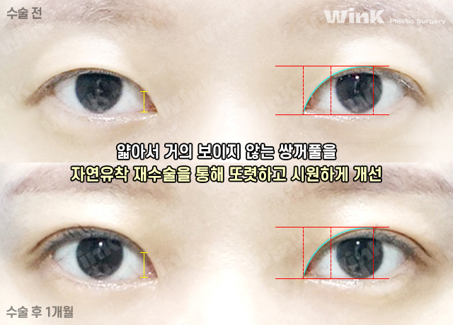 나도 자연유착으로 재수술 할 수 있을까? 관련 이미지 9