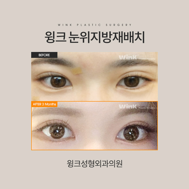눈위지방재배치 눈지방재배치 꺼진 눈꺼풀을 생기 가득하게! 관련 이미지 4