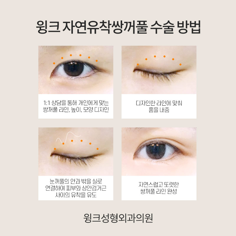 Double-Eyelid Stitching, WINK Plastic Surgery Natural Adhesion image 7