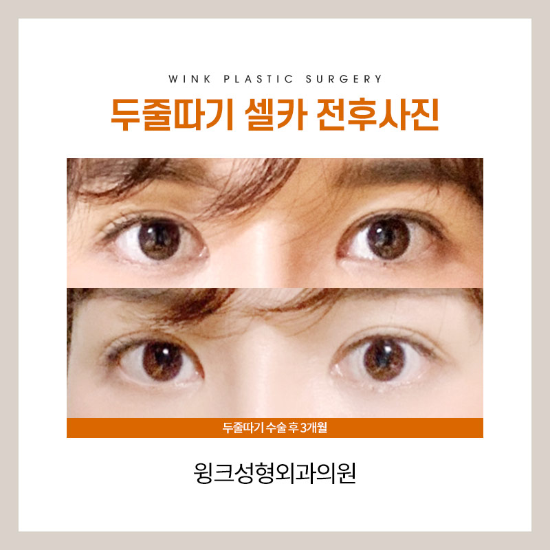Let’s take a look at the differences before and after line lowering. image 7