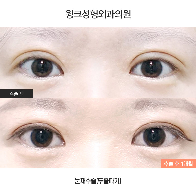 두줄따기 절개 눈재수술로 소세지눈에서 벗어나 볼까요? 관련 이미지 1