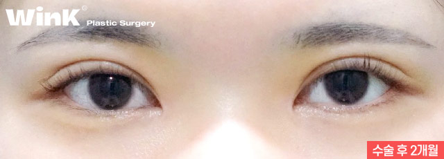 Wink Plastic Surgery Double Eyelid Revision Surgery, Pursuing Natural Results by Identifying the Exact Cause of Failure image 4
