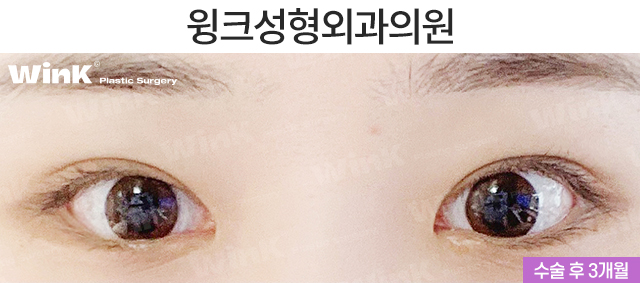 Make a Fierce Eye Shape Look Gentle with Outer and Lower Corner Eye Surgery! image 3