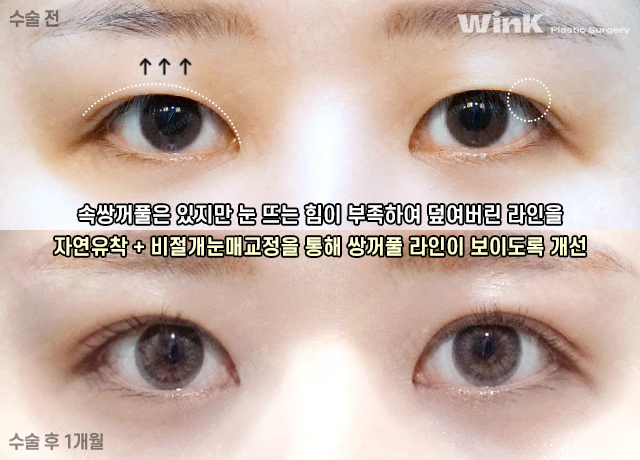 자연스러운 쌍수 맛집 찾고 있다면 윙크성형외과 자연유착쌍꺼풀! 관련 이미지 7