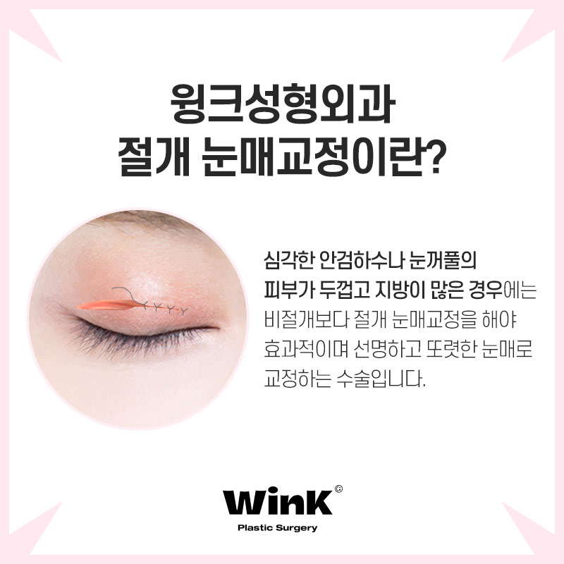 Wink Plastic Surgery Eye Correction for a Natural Look That Doesn't Stand Out image 5