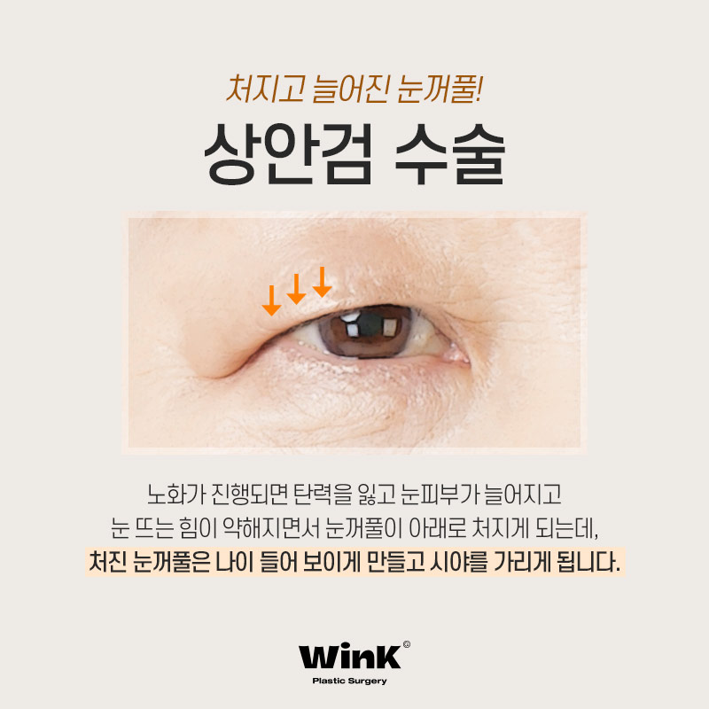 If You’re Worried About Sagging Eyes Due to Aging, WINK Plastic Surgery Upper Blepharoplasty image 3