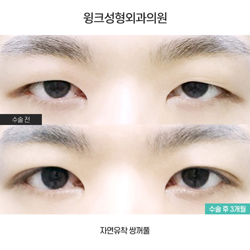남자 자연유착 쌍꺼풀에 관해 알아볼까요? 관련 이미지 1