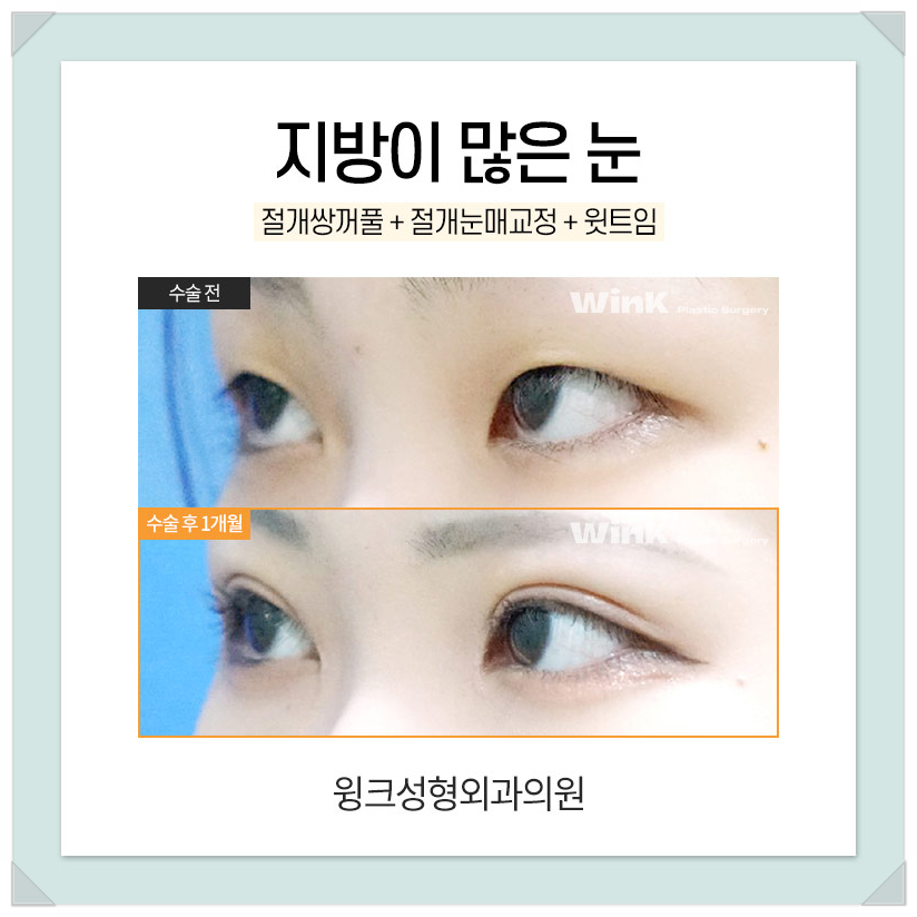 지방이많은눈 눈두덩이지방제거 절개쌍수비용을 알아보겠습니다. 관련 이미지 6