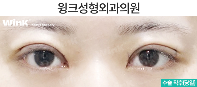 마지막 눈 성형, 눈매교정으로 또렷하게 개선해 드리는 윙크성형외과 눈재수술! 관련 이미지 6