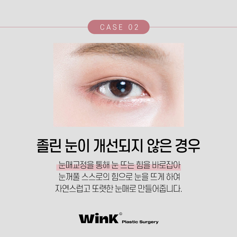 소세지눈재수술 생각한다면? 윙크성형외과 신사역쌍꺼풀재수술 관련 이미지 4