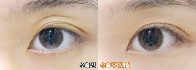 다 같은 라인? 윙크성형외과 심플커브 자연유착은 나에게 꼭 맞는 라인으로! 관련 이미지 6