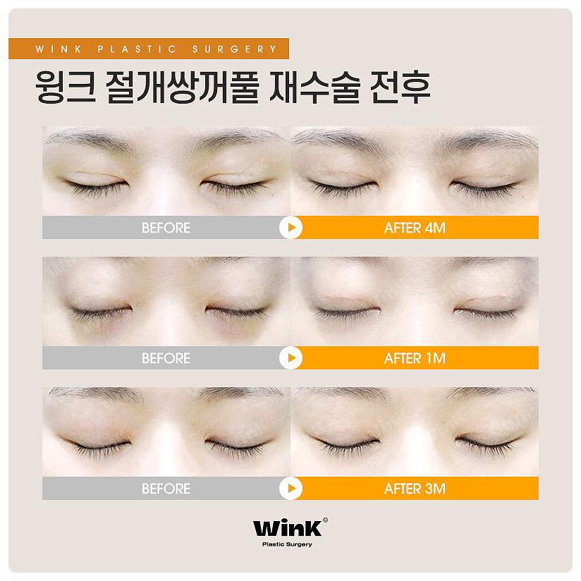 Double Eyelid Surgery Sausage Eyes, Double Eyelid Surgery Scars, Wink Plastic Surgery Double Eyelid Line Lowering, Sinsa Revision Eye Surgery Before and After image 5